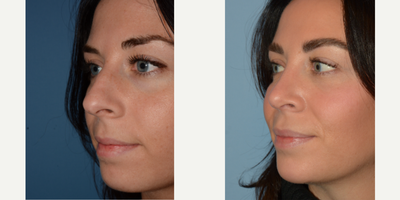 Rhinoplasty before and after photo