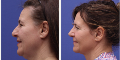 Rhinoplasty before and after photo
