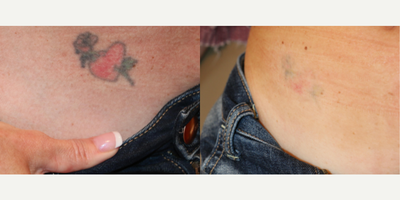 Tattoo Removal before and after photo