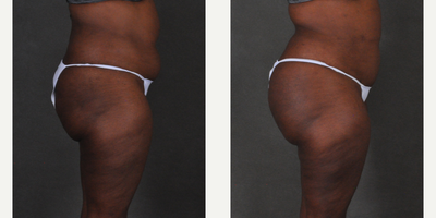 Brazilian Butt Lift before and after photo