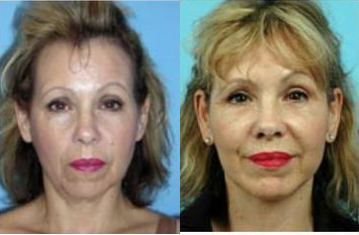 Facelift before and after photo