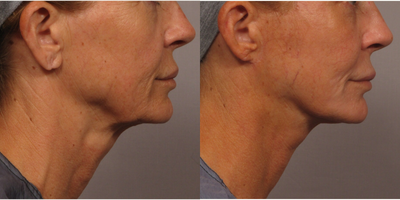 Facelift before and after photo