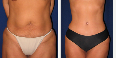 Liposuction before and after photo
