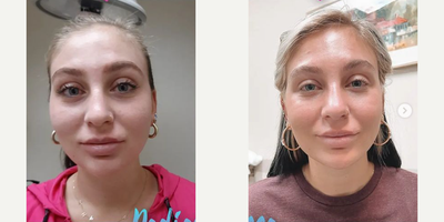 Radiesse before and after photo
