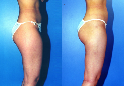 Liposuction before and after photo