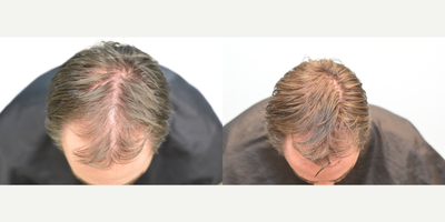 PRP for Hair Loss before and after photo