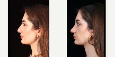 Rhinoplasty before and after photo