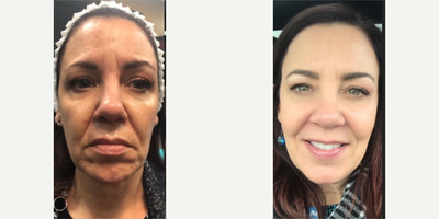 Volbella before and after photo