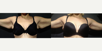 Arm Lift before and after photo