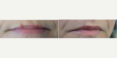 Mole Removal before and after photo