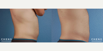 Smart Lipo before and after photo