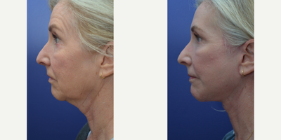 CO2 Laser before and after photo