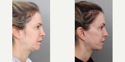 Deep Plane Facelift before and after photo