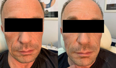 Dermal Fillers before and after photo