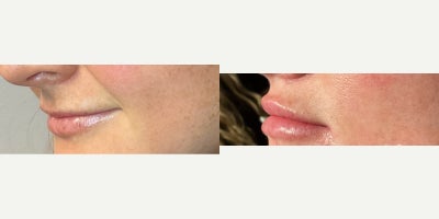 Dermal Fillers before and after photo
