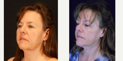 Facelift before and after photo