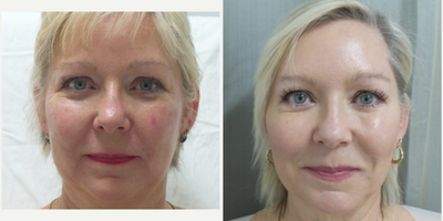 Fractional Laser before and after photo