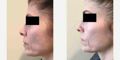Laser Resurfacing before and after photo