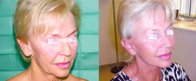 Nonsurgical Facelift before and after photo