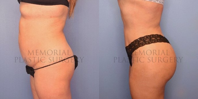 Brazilian Butt Lift before and after photo