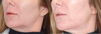 Chin Filler before and after photo