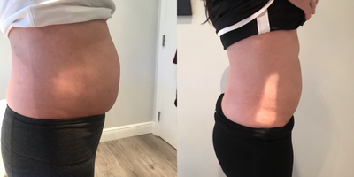 Emsculpt before and after photo