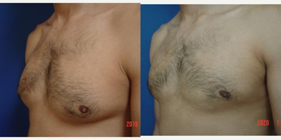 Gynecomastia Surgery before and after photo
