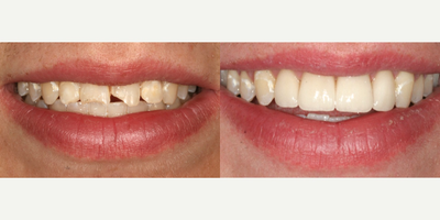 Dental Crown before and after photo