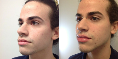 Lip Fillers before and after photo