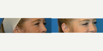 Botox before and after photo