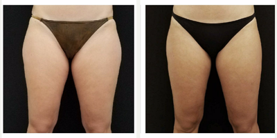 CoolSculpting before and after photo