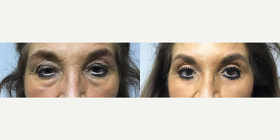 Eyelid Surgery before and after photo