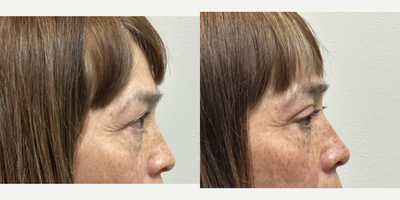 Eyelid Surgery before and after photo