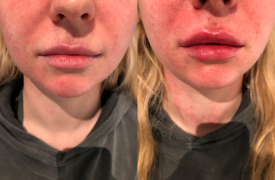 Lip Fillers before and after photo