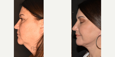 Neck Lift before and after photo