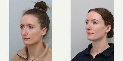 Rhinoplasty before and after photo