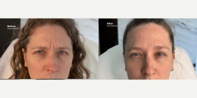 Botox before and after photo
