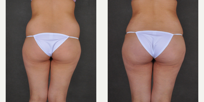 Brazilian Butt Lift before and after photo