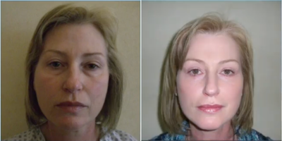Eyelid Surgery before and after photo