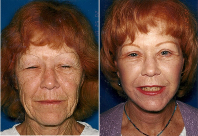 Facelift before and after photo