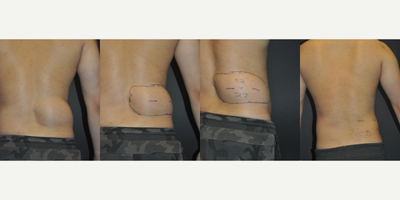 Lipoma Removal before and after photo