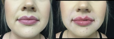 Vollure before and after photo