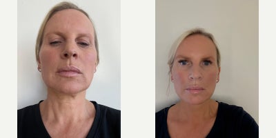 Facelift before and after photo