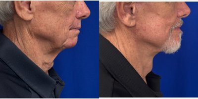Facelift before and after photo