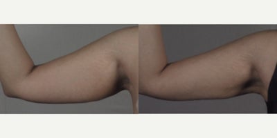 Arm Lift before and after photo