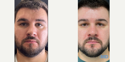 CO2 Laser before and after photo