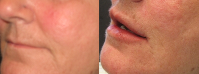 Juvederm before and after photo