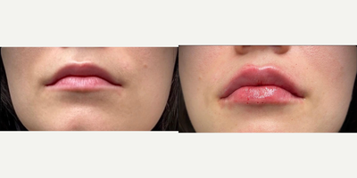 Lip Fillers before and after photo