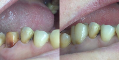 Dental Implants before and after photo