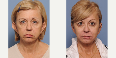 Ear Surgery before and after photo